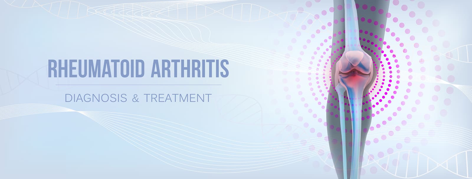 Diagnosi e trattamenti per l artrite reumatoide