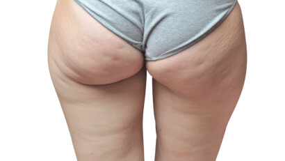 Miti, cause e rimedi per la cellulite efficaci