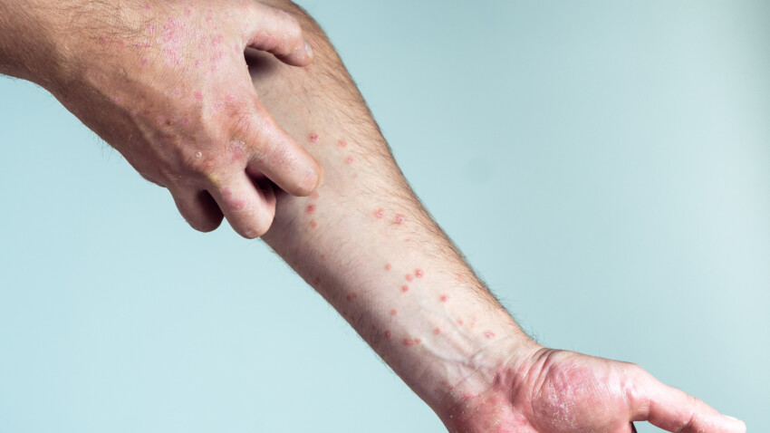 Quando i probiotici possono essere dannosi